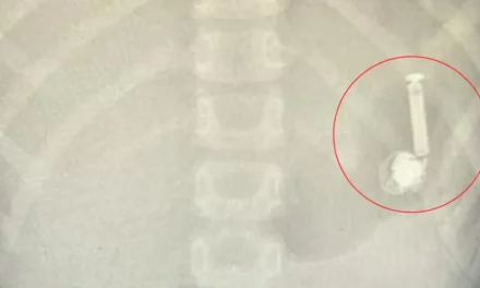 مستشفى سعودي ينجح باستخراج سماعة جوال من بطن طفل